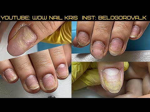 Видео: Травма, ОНИХОЛИЗИС- доносить ВСЕМ с особой СТРОГОСТЬЮ!Неосведомлённость клиентов-какие Последствия