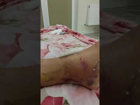 Видео: снял гибс через неделю после перелома лодыжки