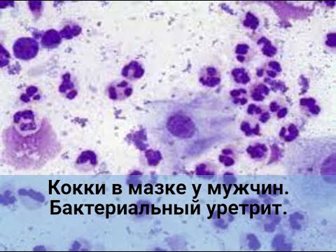 Видео: Кокки в мазке у мужчин. Бактериальный уретрит.