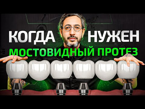 Видео: В каких случаях НУЖНО ставить мостовидный протез