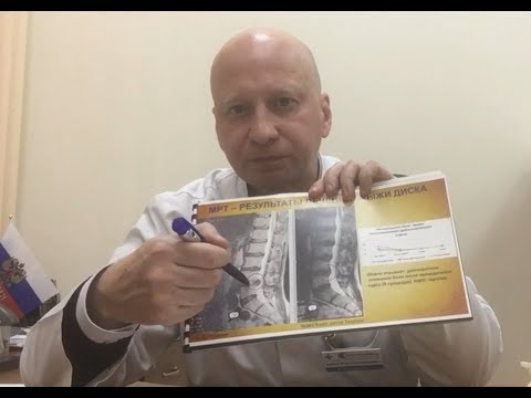 Видео: Лечение межпозвонковой грыжи методом MBST® - терапии