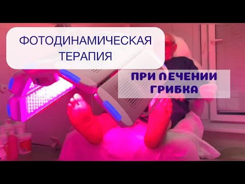 Видео: Результат лечения грибка стопы и ногтей с процедурой ФДТ #подология #подолог #грибокногтей #грибок