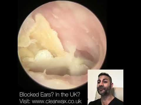 Видео: 1633 — удаление омертвевшей кожи у 98-летнего пациента с помощью iCLEARscope®️ 🦠👂