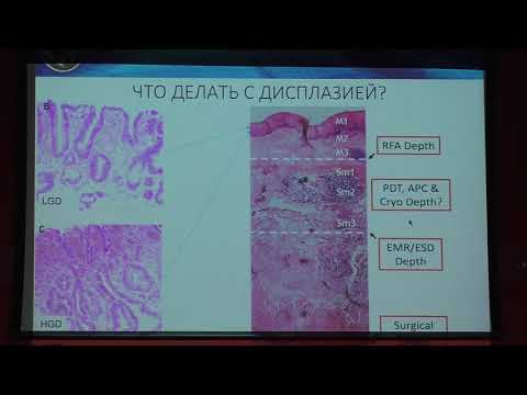 Видео: 05 Сидорова АН Пищевод Барретта Взгляд через эндоскоп