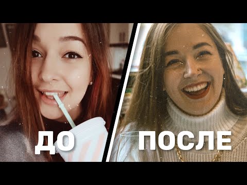 Видео: БРЕКЕТЫ - моя ✨нЕтРиВиАлЬнАя✨ история. СТОИТ ЛИ ОНО ТОГО?