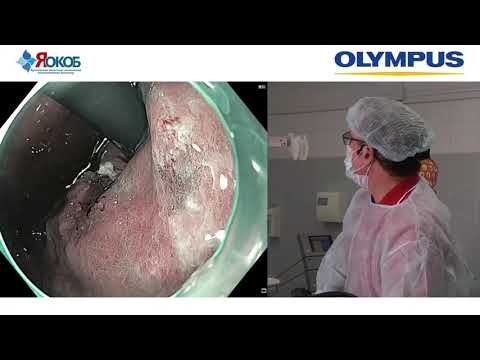 Видео: Эндоскопическая диагностика раннего рака желудка с применением уточняющих методик. С. В. Кашин