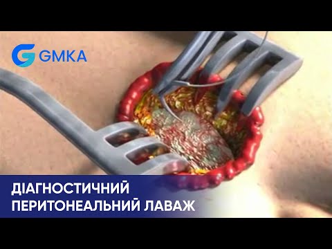 Видео: Як виконати діагностичний перитонеальний лаваж | ATLS