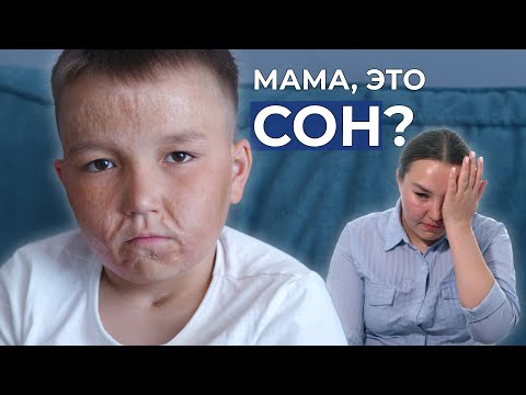 Видео: РУБЦОВЫЕ ДЕФОРМАЦИИ ПОЛОВИНЫ ТЕЛА | История Байраса Мараканова