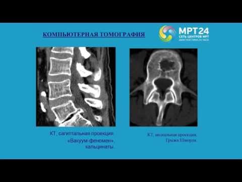 Видео: Дегенеративные изменения позвоночника на МРТ