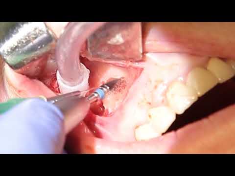 Видео: Резекция верхушки корней зубов. Профессор Орлов