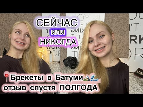Видео: Стоматолог с БРЕКЕТАМИ. 😬Промежуточный результат спустя полгода.Батуми.