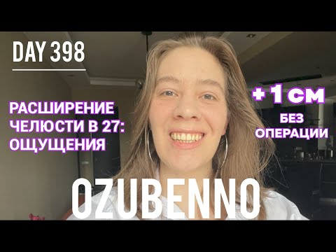 Видео: БЕЗ БРЕКЕТОВ день 398: ощущения в начале лечения на аппарате Планас