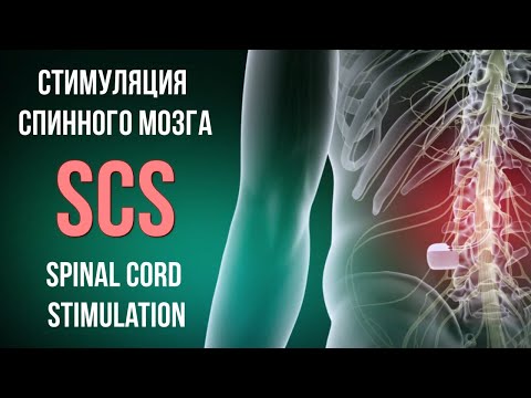 Видео: Стимуляция спинного мозга в РНХИ им. проф.  А.Л. Поленова