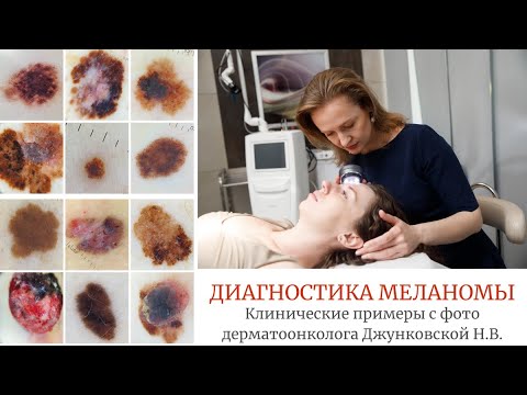Видео: Меланома кожи. Фото дерматоскопических снимков.