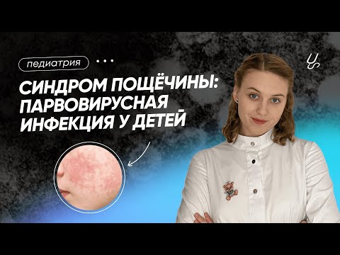 Видео: Синдром пощёчины: парвовирусная инфекция у детей