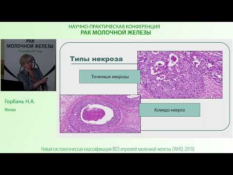 Видео: Неинвазивный протоковый рак молочной железы (DCIS)