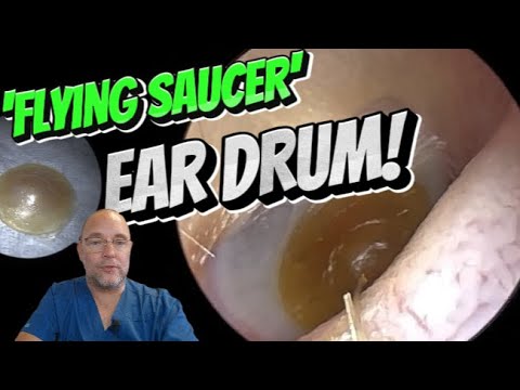 Видео: Барабанная перепонка в форме «летающей тарелки»! 341 #ухо #ушнаясера #удалениеушнойсеры #асмр #уд...