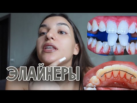 Видео: ЭЛАЙНЕРЫ🦷до и после, сколько я потратила, плюсы и минусы