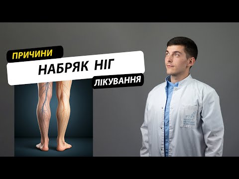 Видео: Набряки ніг. Причини, лікування, профілактика.