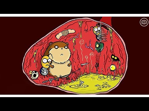 Видео: 02-12 Язвенная болезнь желудка