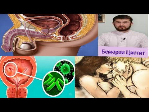 Видео: Цистит (сузок) ! Сабаб аломат пешгири ва табобати бемории цистит.
