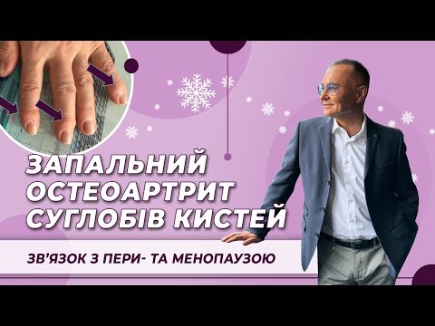 Видео: Запальний остеоартрит суглобів кистей   звʼязок з пери - та менопаузою
