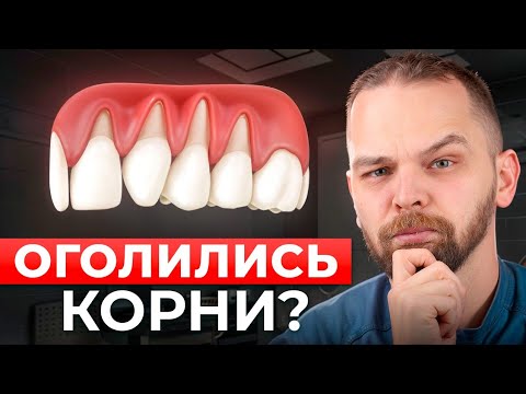 Видео: Опустилась десна? Вот что нужно сделать