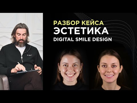 Видео: Как планировать эстетический кейс с десневой улыбкой? Разбор с использованием Digital Smile Design