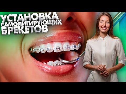 Видео: Как устанавливают безлигатурные самолигирующие брекеты?