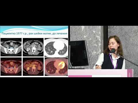 Видео: Место ПЭТ-КТ в диагностике рака шейки матки и наблюдении за больными