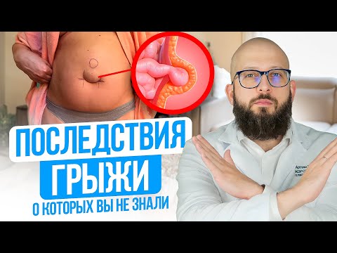 Видео: ПОСЛЕДСТВИЯ ПУПОЧНОЙ ГРЫЖИ о которых молчат доктора. Современные методы лечения пупочной грыжи