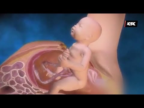 Видео: АПТАП / Кесар тілігінің кесірі қандай? / 28. 01. 2018