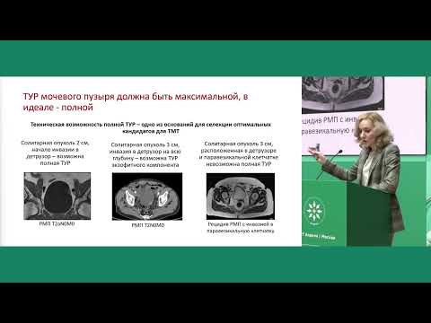 Видео: Неметастатический мышечно-инвазивный рак мочевого пузыря: обзор существующих опций