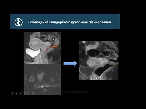 Видео: Петрова A.С. «МРТ в оценке эффективности лечения рака шейки матки. Трудности диагностики»