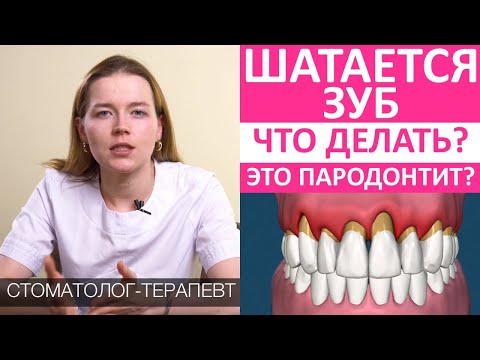 Видео: Шатается зуб. Что делать? Пародонтит: причины, последствия, лечение. Расшатывание, подвижность зубов