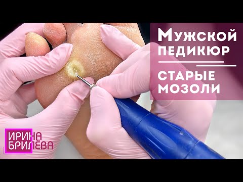 Видео: Мужской педикюр 🌸 Старые мозоли