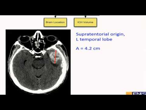 Видео: Геморрагический инсульт(Intracranial hemorrhage)   Gene Yong Sung USA 2019