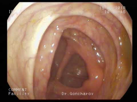 Видео: Очаговая гиперплазия слизистой при хроническом воспалении (включите субтитры)