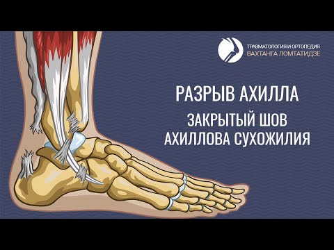 Видео: Разрыв ахилла. Закрытый шов ахиллова сухожилия.