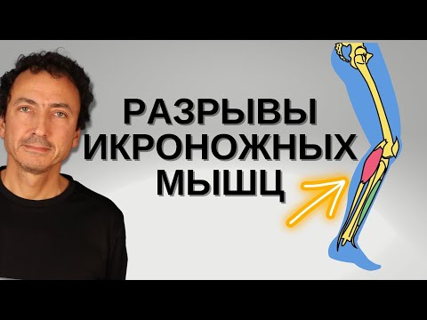 Видео: Разрывы икроножных мышц