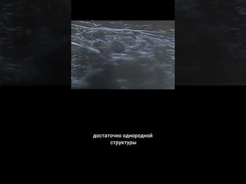 Видео: #узи #лимфаденопатия