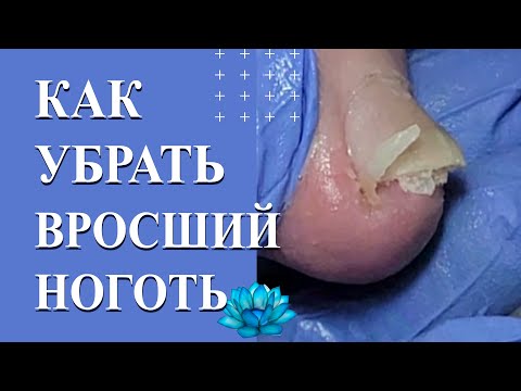 Видео: Онихолизис ногтей на ногах. Лечение вросшего ногтя. Скоба фрезера.