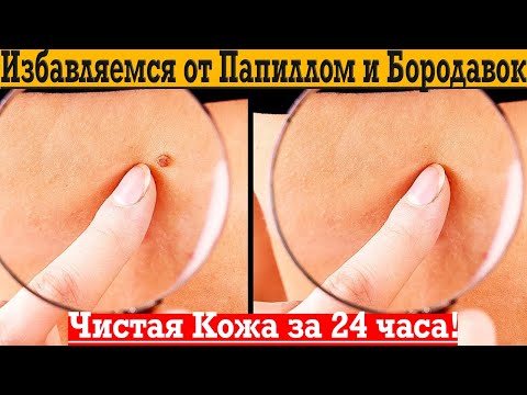 Видео: Избавляемся от папиллом и бородавок всего за 24 часа!