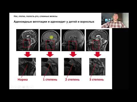 Видео: Что такое антигенная разгрузка?