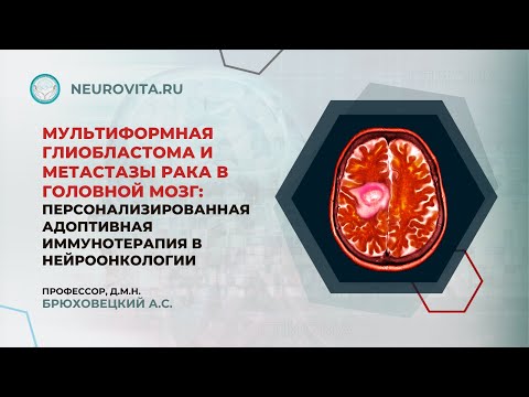 Видео: Мультиформная глиобластома и метастазы рака в головной мозг