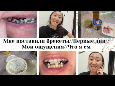 Видео: МНЕ ПОСТАВИЛИ БРЕКЕТЫ😬//ПЕРВЫЕ ДНИ// МОИ ОЩУЩЕНИЯ🤪//ЧТО Я ЕМ🫕