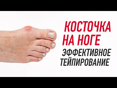 Видео: ✅ КОСТОЧКА НА НОГЕ. ЭФФЕКТИВНОЕ ТЕЙПИРОВАНИЕ | Валентин Гайт | Учебный центр BBALANCE