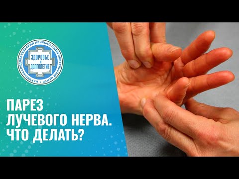 Видео: 🤏 Парез лучевого нерва. Что делать?