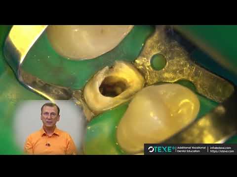 Видео: Радлинский   Бонус видео 2  Реставрация верхнего премоляра