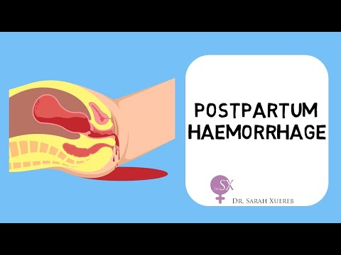 Видео: Послеродовое кровотечение
